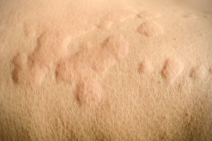 urticaria skin rash